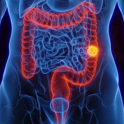 SUS adota novo exame para detectar câncer de intestino antes dos sintomas