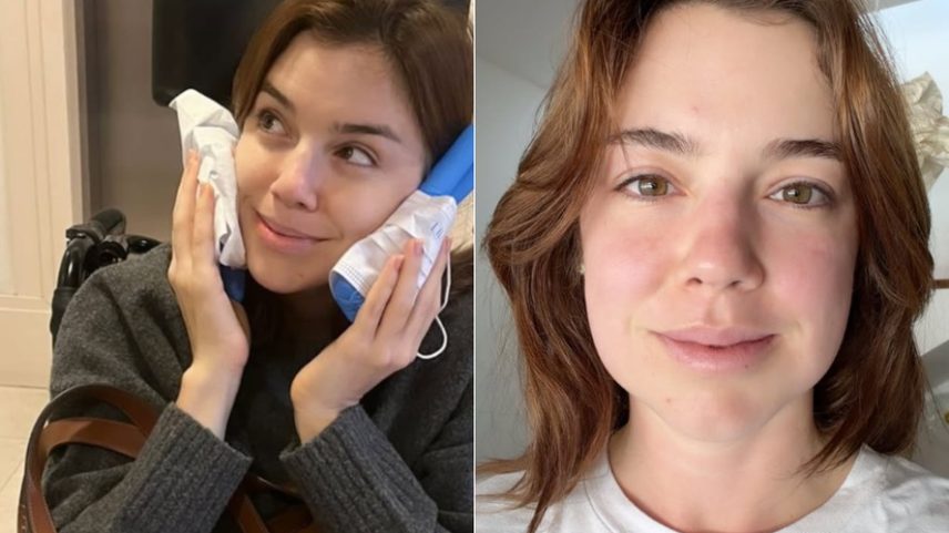 Alice Wegmann mostra resultado após retirada dos sisos e brinca: “Estou igual ao Kiko” — Foto: Reprodução/Instagram