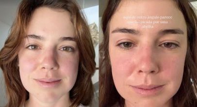 Alice Wegmann revela procedimento recente e mostra inchaço no rosto