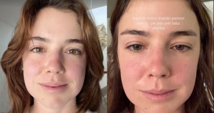 Alice Wegmann contou que precisou retirar os últimos sisos, além de ter congelado seus óvulos