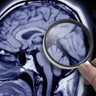 Teste rápido pode prever risco de Alzheimer décadas antes dos sintomas
