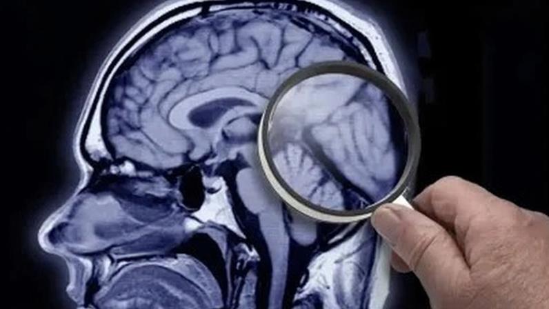Estudos indicam que o acúmulo da proteína beta-amiloide, principal biomarcador do Alzheimer, pode começar até 30 anos antes dos sintomas clínicos