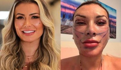 Andressa Urach ultrapassa 50 cirurgias plásticas e relembra procedimentos