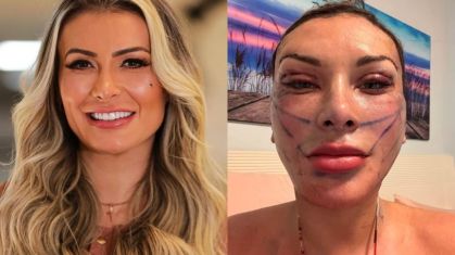 Andressa Urach acaba de passar por novo procedimento estético
