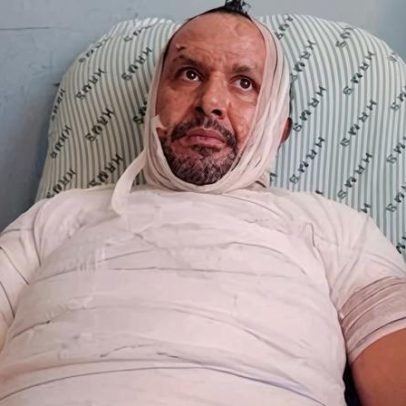 Homem sofre queimaduras graves ao acender churrasqueira com álcool no MS