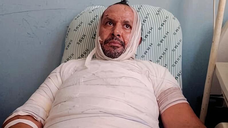 Imagem colorida, homem queima quase todo corpo ao acender churrasqueira com álcool - Metrópoles