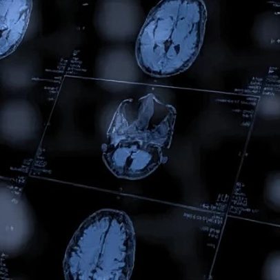 Estudo aponta promessa de vacina personalizada para câncer cerebral