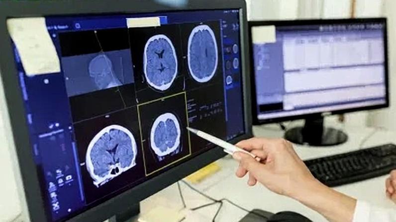 Pesquisa revela que o declínio neurológico visível em exames é impulsionado por anticorpos que atacam o organismo por engano