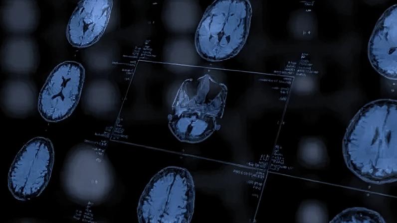 Vacina pode aumentar eficácia de tratamento contra câncer cerebral agressivo