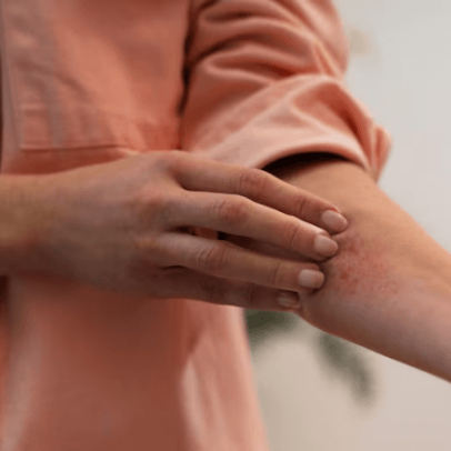 Dermatite atópica piora no frio seco; veja dicas de cuidado com a pele