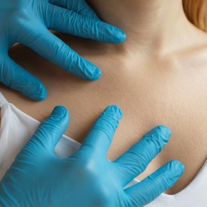 Médica ensina prevenção de melanoma agressivo no Melanoma Monday