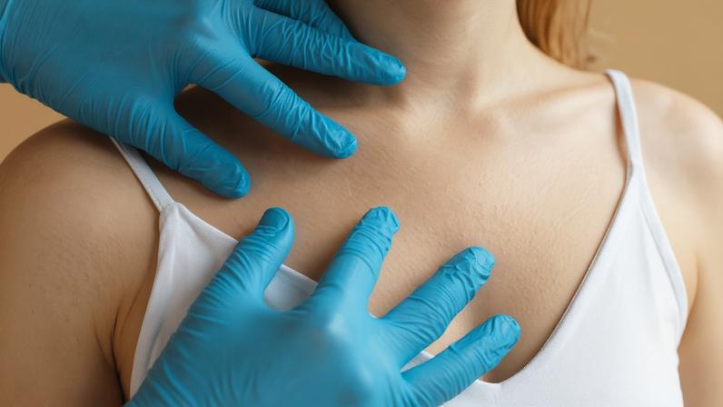 foto de câncer de pele do tipo melanoma