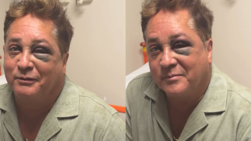 Leonardo aparece com olho roxo após acidente