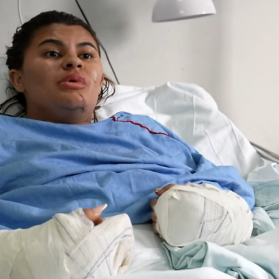 Jovem diz ter fingido de morta para escapar após mãos decepadas pelo cunhado