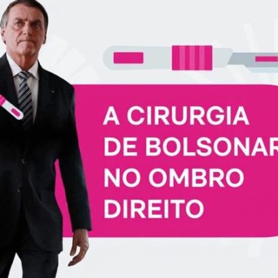 Cirurgia no ombro direito de Bolsonaro: entenda o procedimento