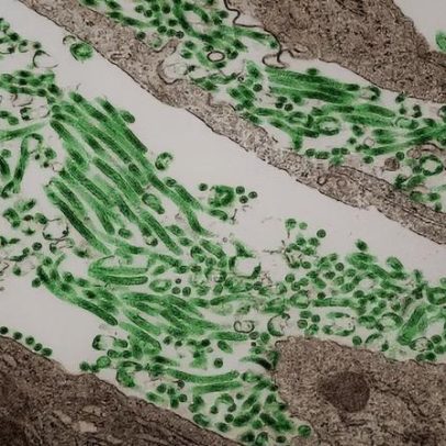 Suspeita de Ebola: homem chega em estado grave, afirma Ministério da Saúde