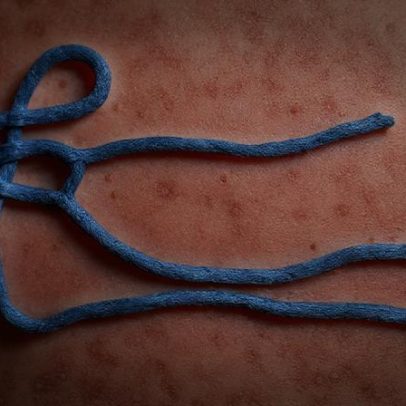 Ebola na África: entenda as causas dos surtos