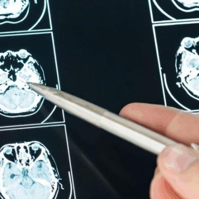 Avanços científicos abrem perspectivas no tratamento de tumores cerebrais