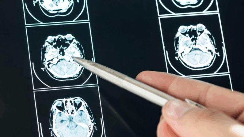 O articulista explica que os fatores de risco associados aos tumores cerebrais ainda não são tão bem estabelecidos. Na imagem, exame de raio-x para identificação de tumor cerebral