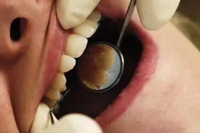 Pacientes de dentista aposentado alertados sobre vírus de sangue, incluindo HIV