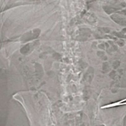 Mulher encontra tesoura de 15 cm no abdômen sete meses após cirurgia plástica