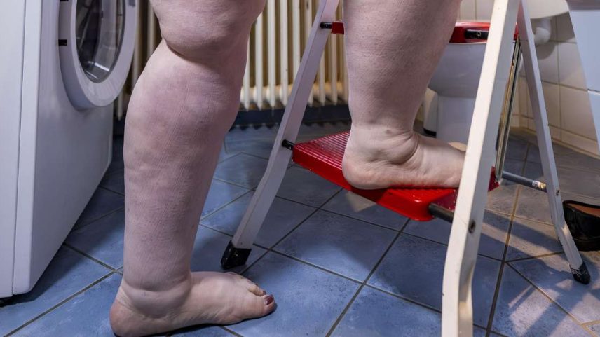 Embora os primeiros relatos da doença sejam datados dos anos 1940, apenas em 2022 o lipedema passou a ter um código próprio no Cadastro Internacional de Doenças (CID)