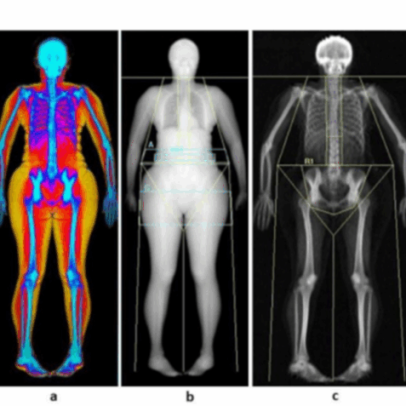Gordura abdominal aumenta risco de incontinência urinária em mulheres