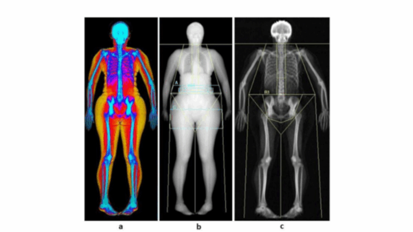 Estudo sobre gordura abdominal e incontinência urinária