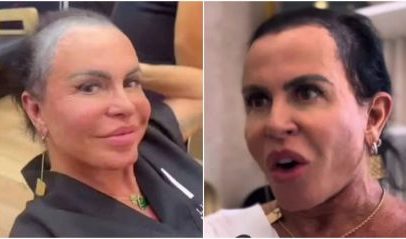 Gretchen relata complicação em tratamento contra alopecia após procedimento