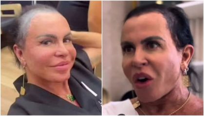 Gretchen relata complicação em tratamento contra alopecia após procedimento