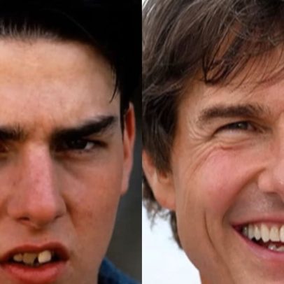 Tom Cruise, Glória Pires e Cristiano Ronaldo investem em renovação dentária