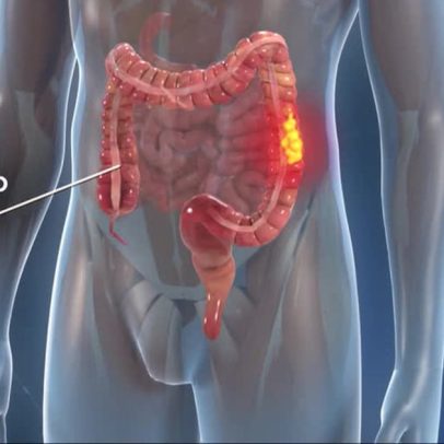 Exames de detecção precoce do câncer de intestino mais que dobraram na década