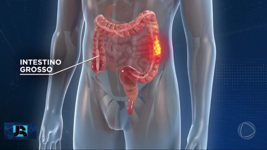 Número de exames para detecção precoce do câncer de intestino mais que dobra na última década