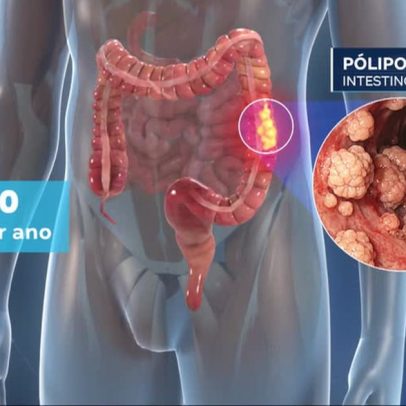 SUS adota novo exame de detecção do câncer colorretal