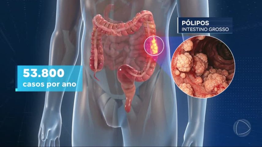 SUS adota novo exame para detecção do câncer colorretal
