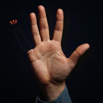 Trabalhador amputado recebe dedo 3D e será indenizado
