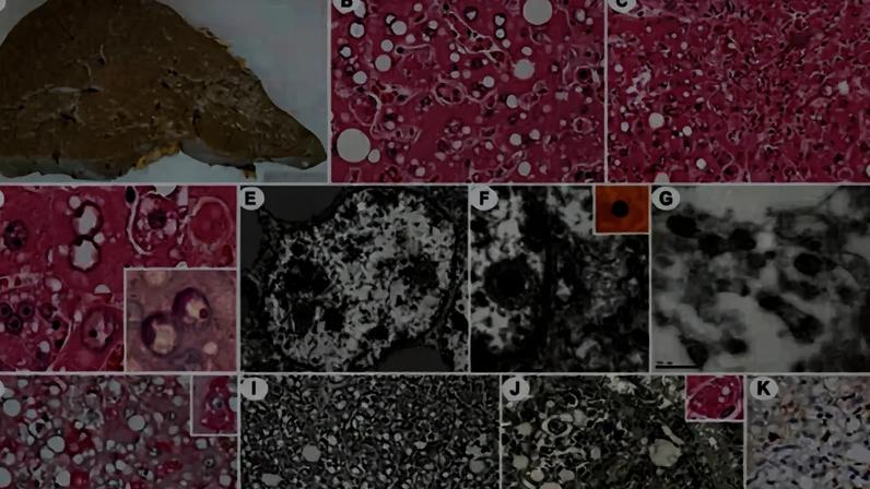 Raro e letal, o vírus Sabiá desafia exames tradicionais e reforça a importância da vigilância genômica. Na imagem, fígado danificado pelo vírus — Foto: Faculdade de Medicina da USP