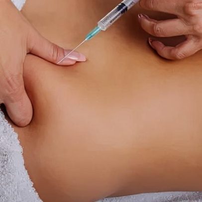 PMMA é proibido para estética no Brasil, exceto em uma única situação