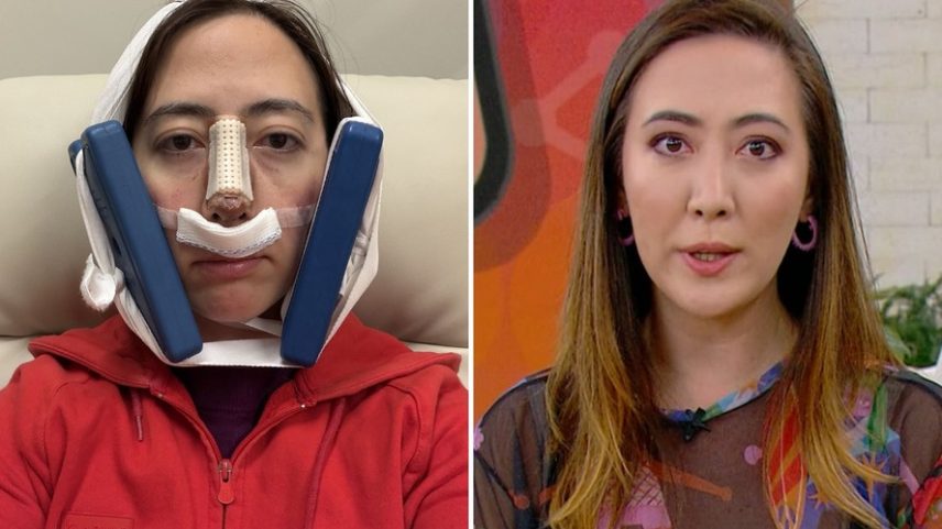 Um mês depois de cirurgia, Ju Massaoka teme sequelas e diz que PMMA pode ter se espalhado: 'Foi um choque'