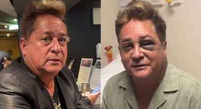 Leonardo explica acidente de pescaria que ocasionou fratura no rosto