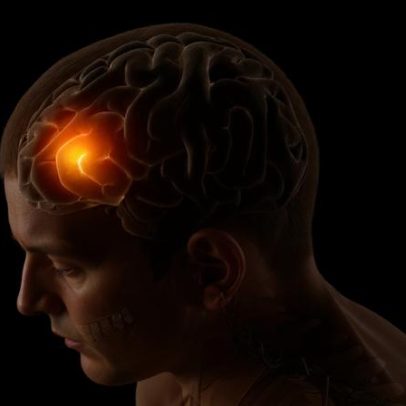 Neurologista aponta sinais silenciosos do AVC que passam despercebidos