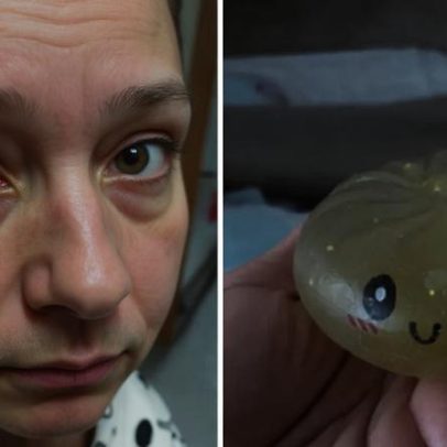 Menina de 10 anos sofre queimadura no rosto em trend do TikTok com brinquedo