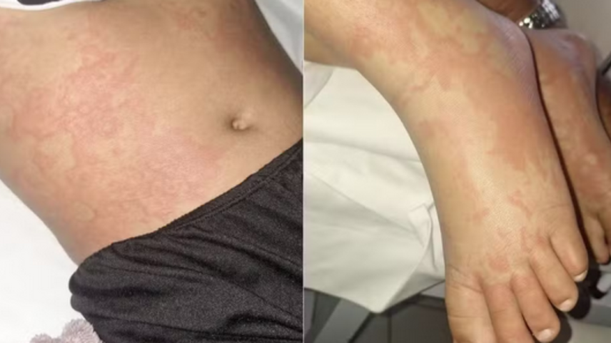 Família acredita que menina teve reação alérgica por estar com um corte na mão quando usou o detergente