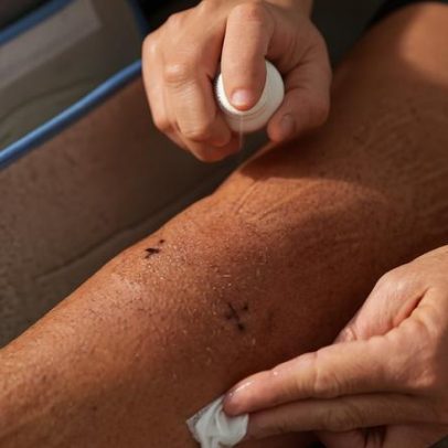 Mulher enfrenta complicações após picada de mosquito durante viagem