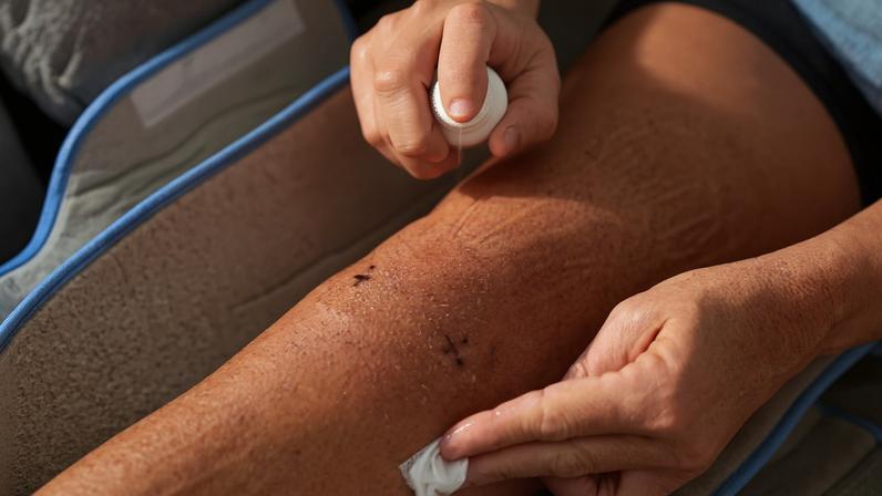 1 de 1 Picada de mosquito - Foto: Getty Images