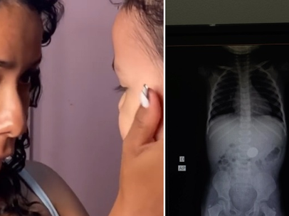 Filha revela o que engoliu; raio-X confirma e mãe fica surpresa