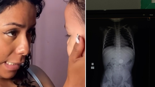 Mãe fica sem reação após filha revelar o que engoliu e raio X confirma