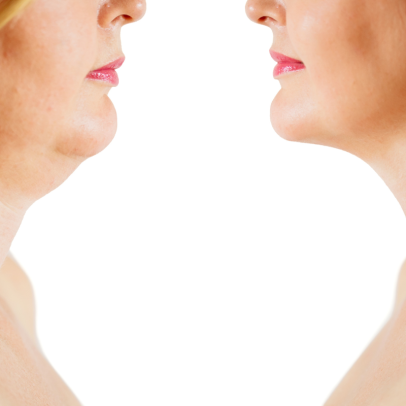 Procedimento pouco conhecido promete rejuvenescimento facial