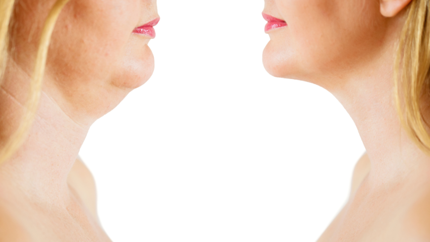 Procedimento pouco conhecido promete rejuvenescimento facial