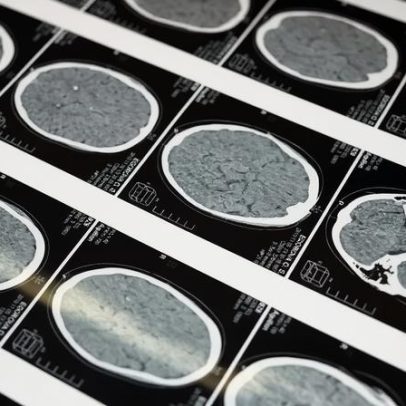 Atividade física pode acelerar limpeza do cérebro, segundo estudo